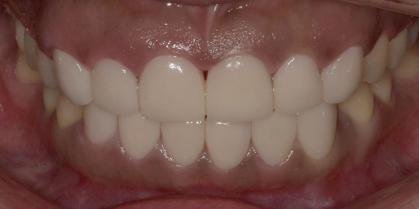 작은치아라미네이트, 전후 비교와 비용 설명까지 관련 이미지 9