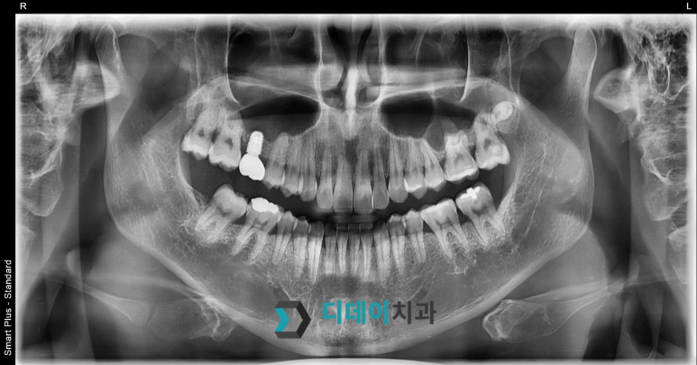 선릉역치과 임플란트 잘하는 곳? 의사라면 딱 이것만 확인합니다 관련 이미지 6
