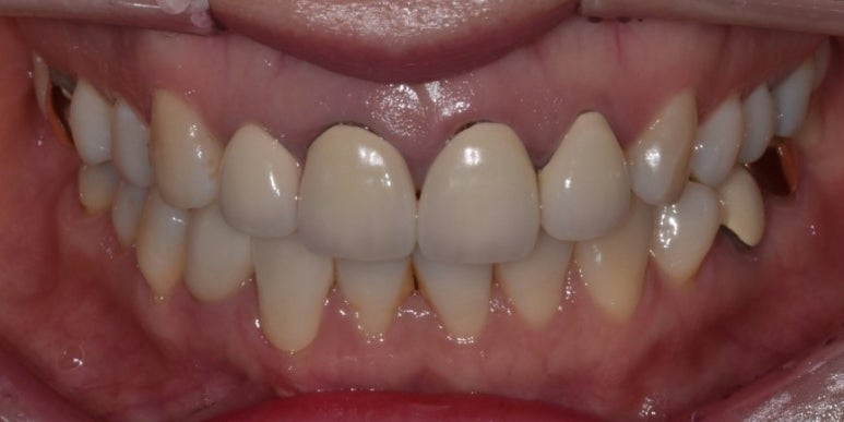 충치치료크라운 비용, 재료별 장단점까지 전부 공개 관련 이미지 6