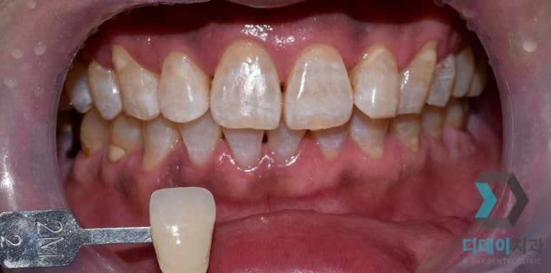 강남치아미백, 금세 또 착색되는 이유와 원데이 치료사례 관련 이미지 7