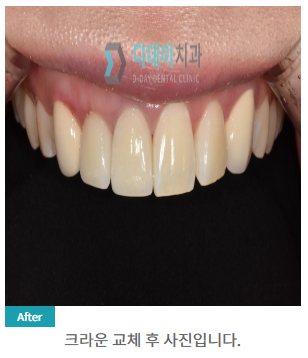 실활치미백, 만족도 높은 환자들의 공통점 3가지 관련 이미지 6