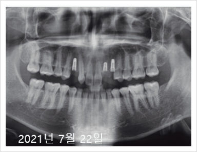 디지털임플란트 가격? 관련 이미지 3