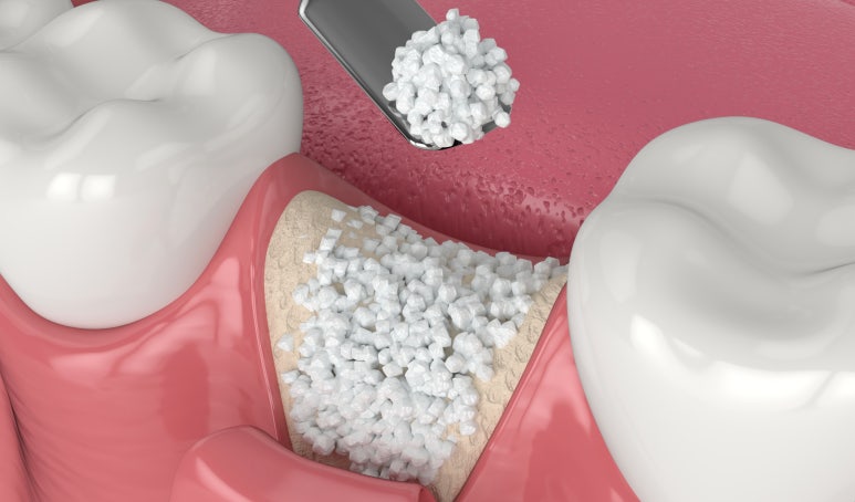 어금니 발치후 임플란트 기간? 식립 시기 모르면 후회합니다 관련 이미지 5