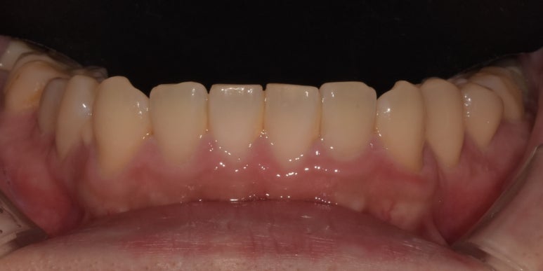 아랫니라미네이트, 잘하는 치과 찾는 2가지 기준 의사 작성 관련 이미지 5