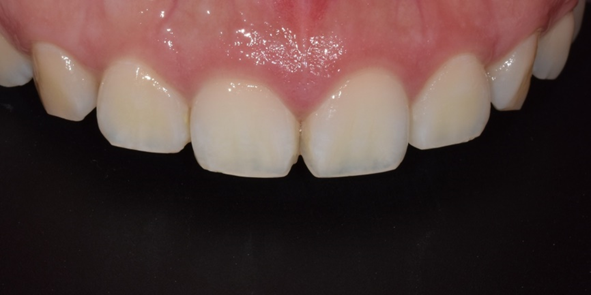 잇몸절제? 절개없이 레이저로 잇몸성형한 후기 관련 이미지 4