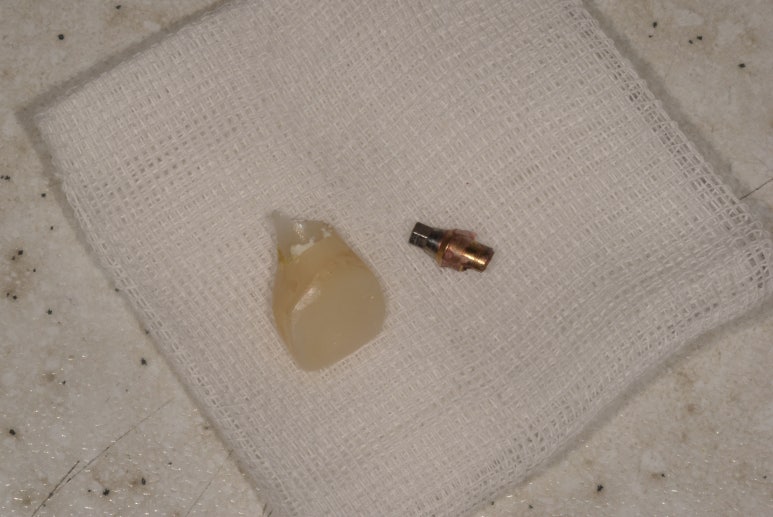 임플란트깨짐, 단순한 문제가 아닐 수 있습니다. 관련 이미지 6