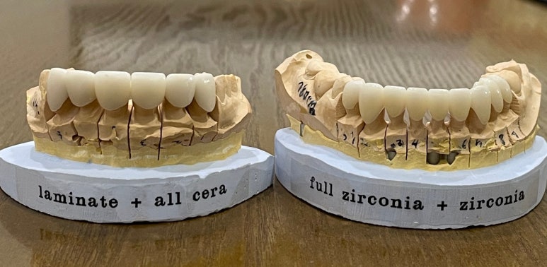 라미네이트, 치아보험 적용이 가능할까요? 관련 이미지 4