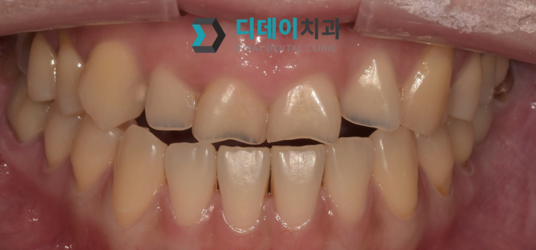 치아쪼개짐, 바로 치과 안가면 신경치료까지 갑니다 관련 이미지 3