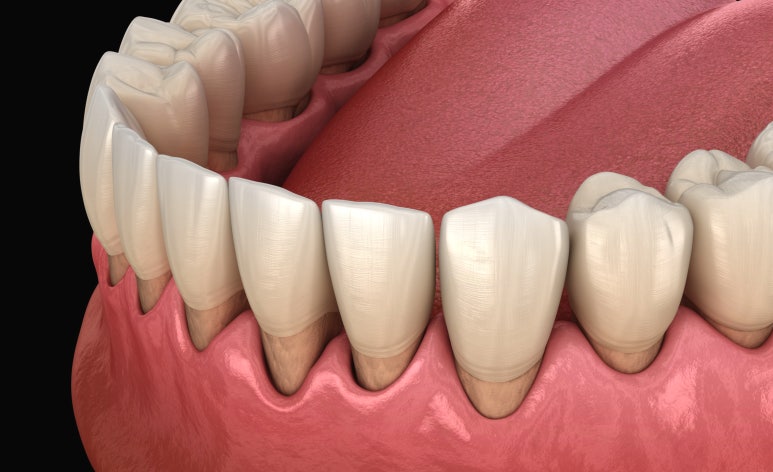 20대잇몸퇴축? 이식수술만이 답은 아닙니다. 관련 이미지 1