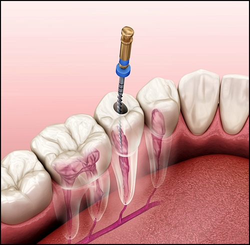 치아 크라운 수명, 끝까지 쓰는 방법 1가지 관련 이미지 4