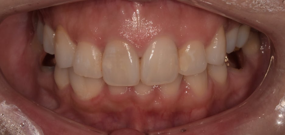 프로필 촬영 전 치아미백 꼭 필요할까요? 관련 이미지 9