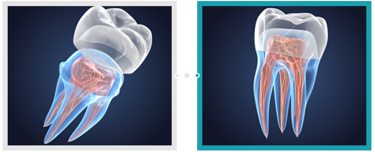 치아크라운비용, 금? 지르코니아? 전부 다 알려드립니다. 관련 이미지 8