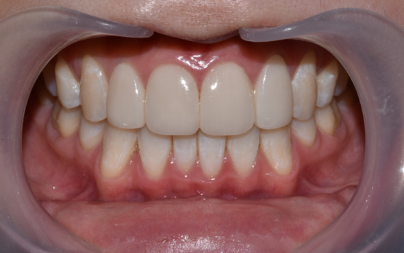 치아미백유지기간부터 종류, 주의사항까지 알려드립니다 관련 이미지 11