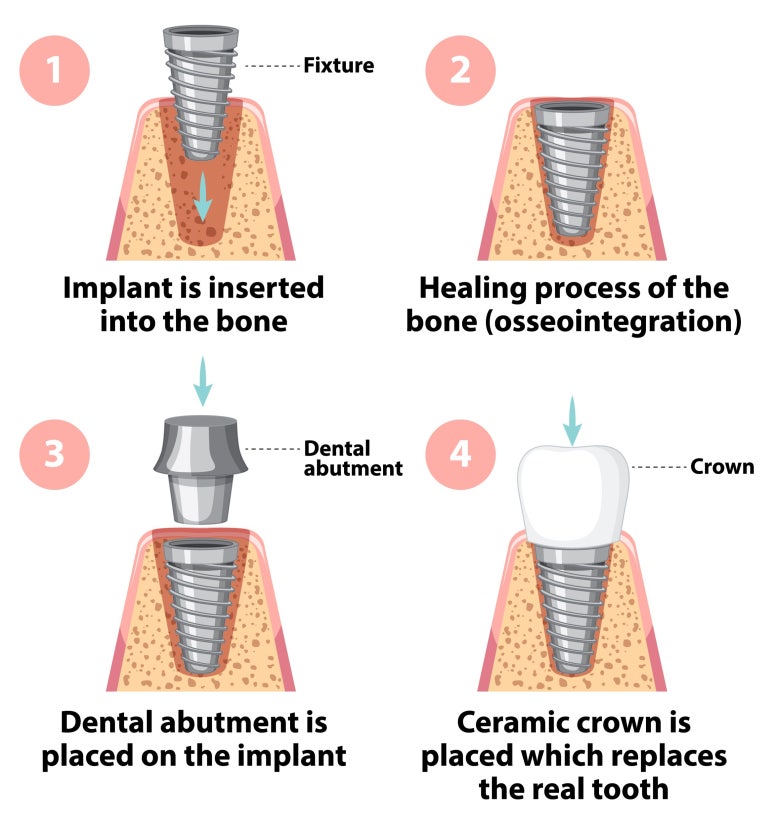 임플란트치과? 선택 기준 확실히 잡아드립니다. 관련 이미지 3