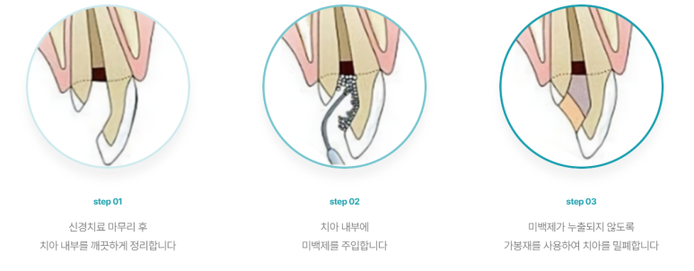 치아 검은색 밝혀주는 실활치미백, 얼마나 밝아지는지 보여 드리겠습니다. 관련 이미지 3