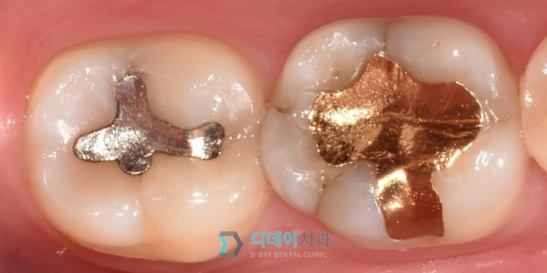 세라믹인레이장점과 단점 솔직하게 말씀드립니다 관련 이미지 5