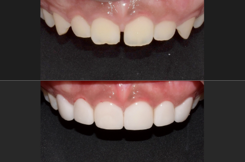 라미네이트 치과? 라미네이트 잘하는 치과 특징 3가지 관련 이미지 2