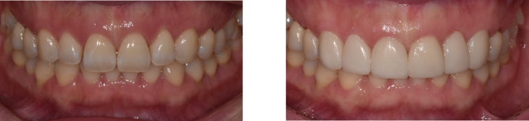 무삭제라미네이트, 아무나 못 하는 이유 관련 이미지 3