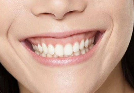 Gum Contouring Near Yeoksam Station: “No One Else Notices, but I’m the Only One Concerned”? That’s Reason Enough image 3