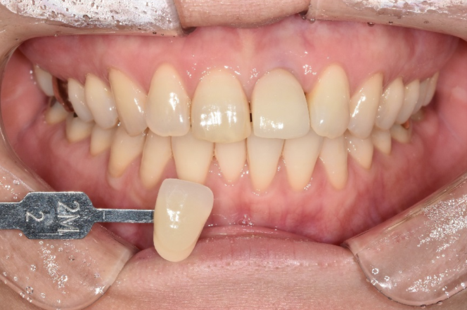 치아미백유지기간부터 종류, 주의사항까지 알려드립니다 관련 이미지 4