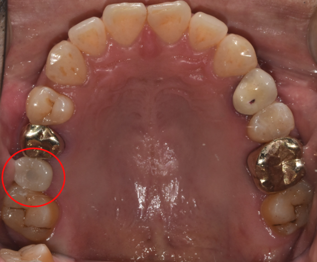 청담역치과? "뼈이식 없이" 임플란트 진행 사례 관련 이미지 8