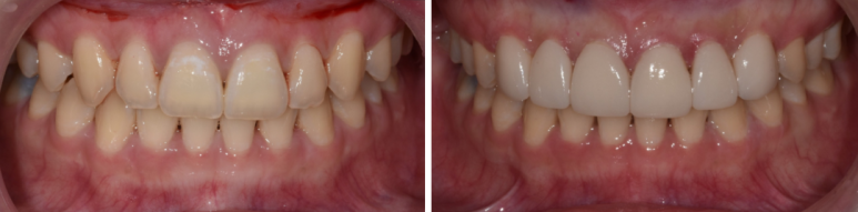 최소삭제라미네이트, 비용부터 치과 고르는 방법 관련 이미지 5