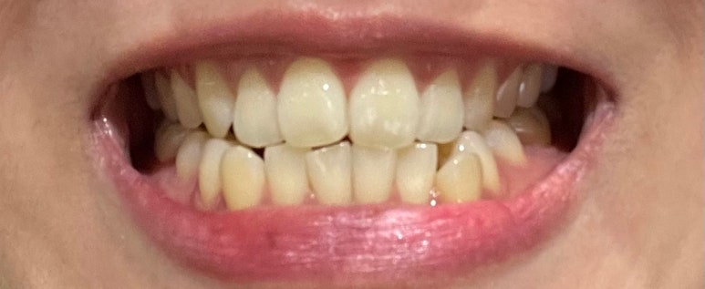 치과치아미백 #내돈내산 찐후기 (feat. 직원이 직접 받은 솔직후기) 관련 이미지 4