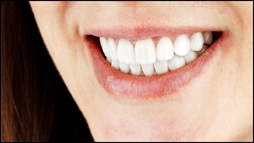 왜소치라미네이트, 치과 의사가 설명해준다면? 관련 이미지 2