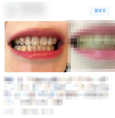 치과치아미백, 700명 이상이 디데이치과를 선택한 이유? 관련 이미지 5