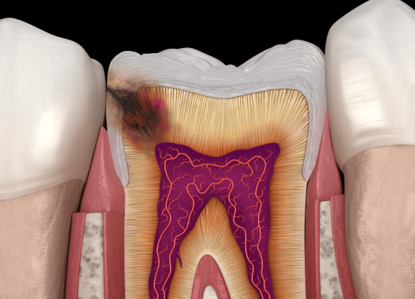 어금니쪽 충치 통증, 관련 이미지 4