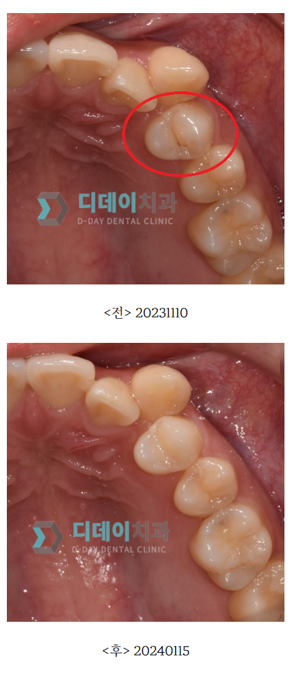도곡동 충치치료,이에 까만 점이 보인다면? 관련 이미지 3