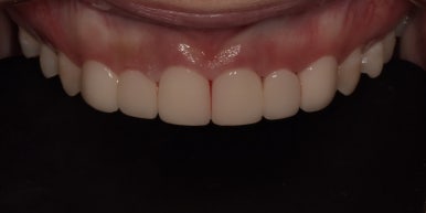 왜소치(작은치아)라미네이트? 치아 모양과 크기, 바꿀 수 있습니다. 관련 이미지 5