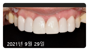 라미네이트치아삭제? "2년간 고민"하셨던 환자분 사례 관련 이미지 3