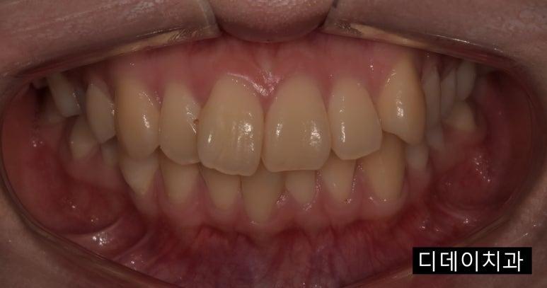 무삭제라미네이트 누구나 다 된다? 속지마세요. 관련 이미지 5