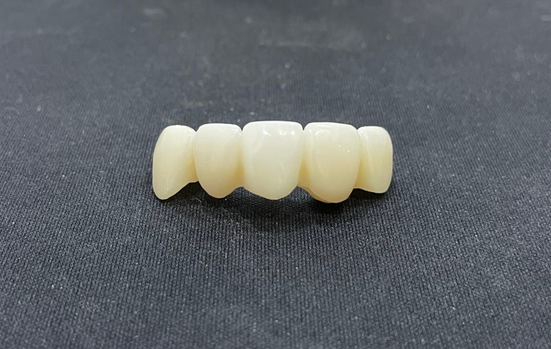 앞니브릿지, 치료기간 앞니 없이 생활해야하나요? 관련 이미지 1