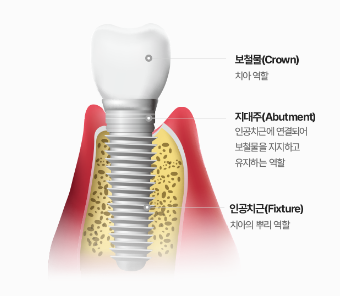 Yeoksam-dong Dental Clinic Implants, Why One Mistake Can Lead to a Lifetime of Regret 〈Written by the Director〉 image 2