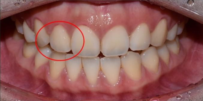 작은이빨, 왜소치? 치아 크기를 키우고 싶은 분만 <필독> 관련 이미지 14