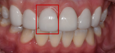 인레이통증? 치료 후 3일 이상 계속되는 분은 보세요. 관련 이미지 4