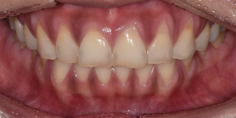 치아도 녹아내린다? 치아부식 원인과 치료방법은? 관련 이미지 6