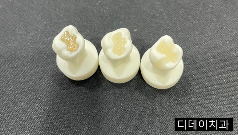 인레이수명, n년밖에 안된다구요? (feat. 적정한 인레이가격은?) 관련 이미지 2