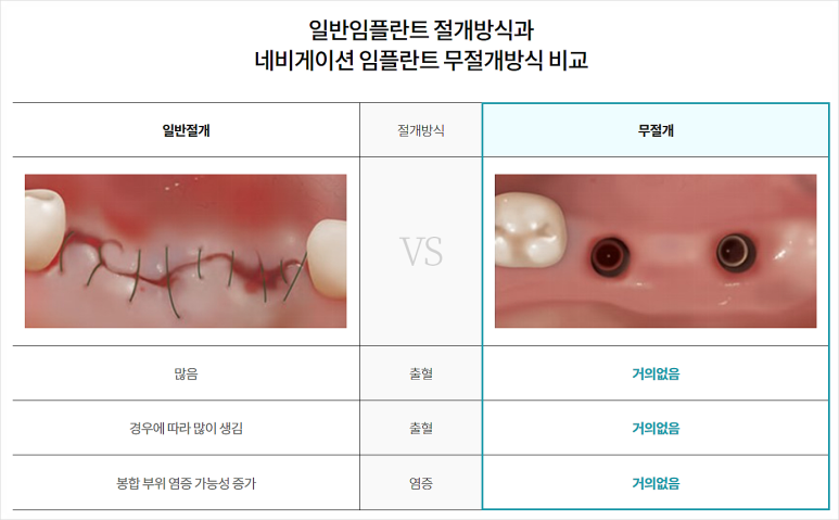 3D임플란트, 네비게이션 비용/통증/과정 총정리 관련 이미지 3