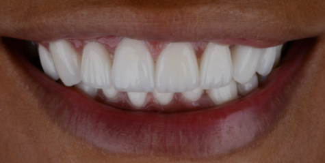 라미네이트재시술?00부터 확인하세요. 관련 이미지 6