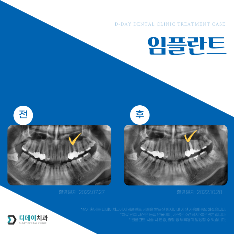 당일임플란트? 반은 맞고 반은 틀립니다. 관련 이미지 5