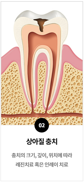 치아인레이가격, 전문의가 알기쉽게 설명해 드리겠습니다. 관련 이미지 4
