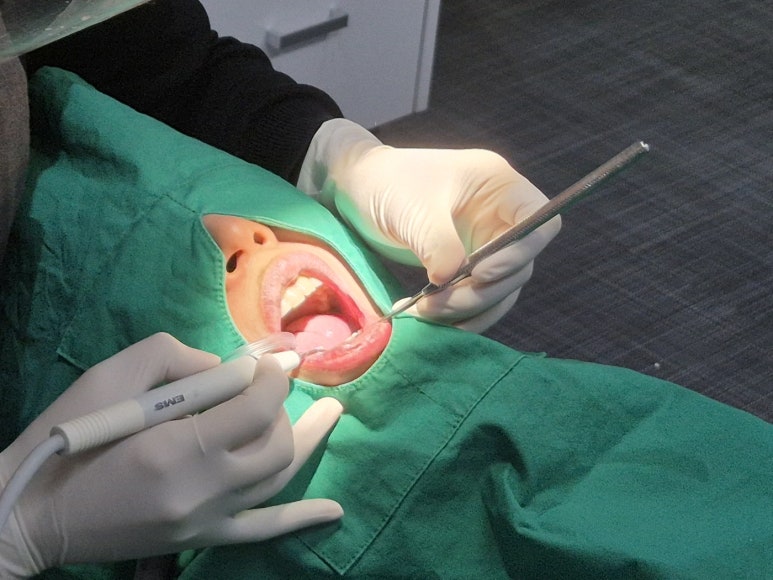 치아검은점, 충치일 확률 90%라는 것은 거짓입니다 관련 이미지 7