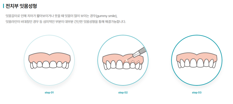 치은성형술, 잇몸이 너무 많이 보여서 웃기 싫었다면 의사 작성 관련 이미지 2
