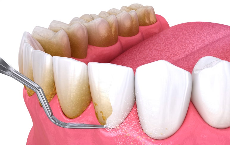 임플란트 교체시기를 늦추는, 치료보다 중요한 관련 이미지 2