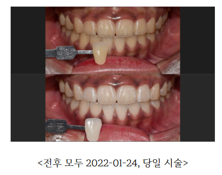 한티역 치아미백 가격부터 전후사진 비교까지 관련 이미지 2