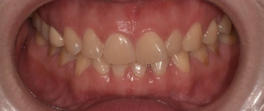 [진심인터뷰] 1n년 고민한 라미네이트, 디데이치과에서 만족도 200%인 이유? ① 관련 이미지 1