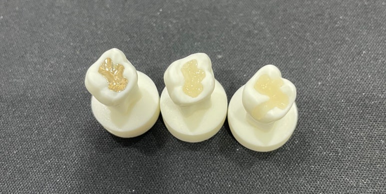 인레이후시림 증상 있다면 필독 관련 이미지 4